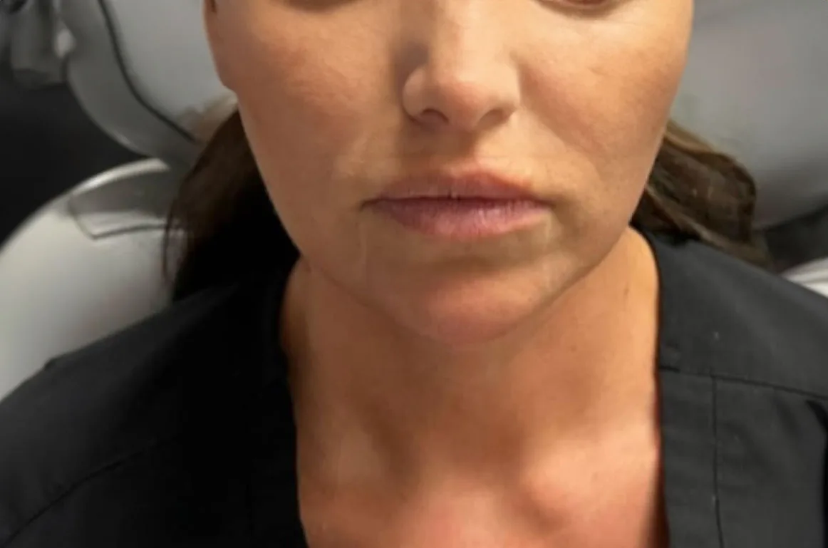 Chin filler profile outcome after structural placement