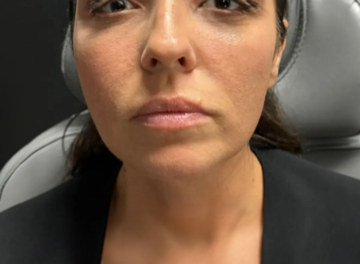 Chin filler profile baseline before treatment