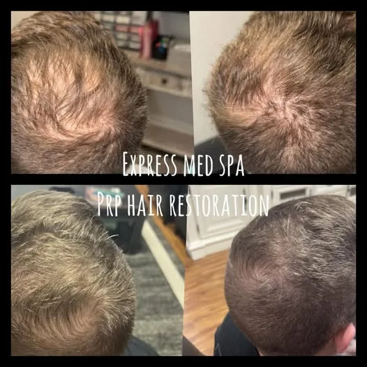 PRP hair restoration before and after clinical results