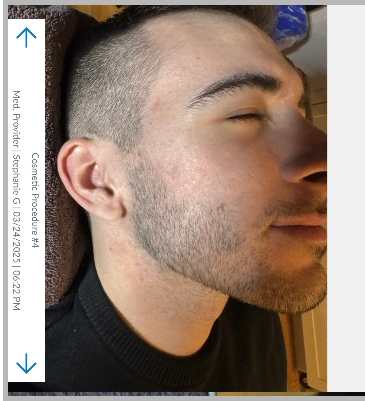 Sublative RF microneedling outcome after clinical series