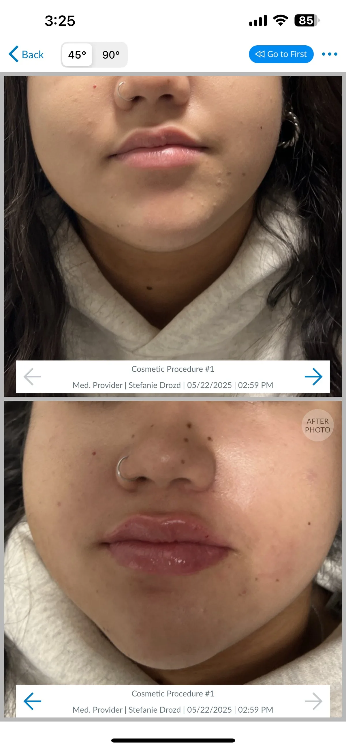 Revanesse Versa lip filler before and after results