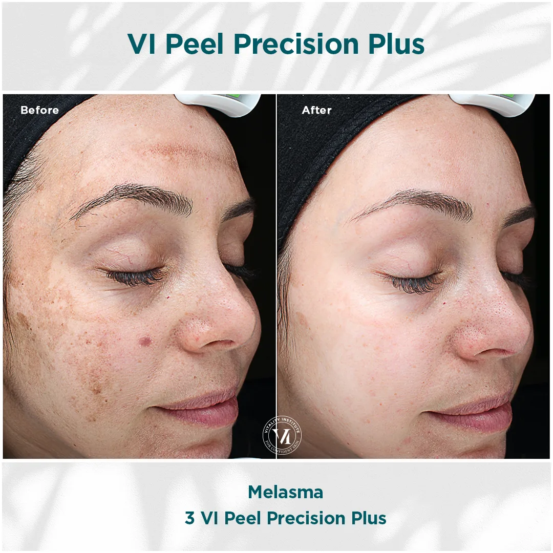 VI Peel clinical outcome demonstrating stubborn melasma clearance