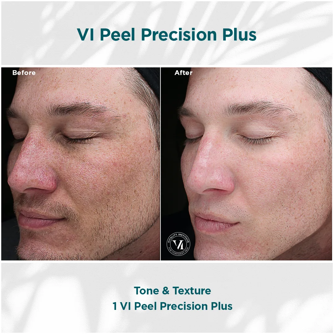 VI Peel Precision Plus clinical results showing tone and texture smoothing