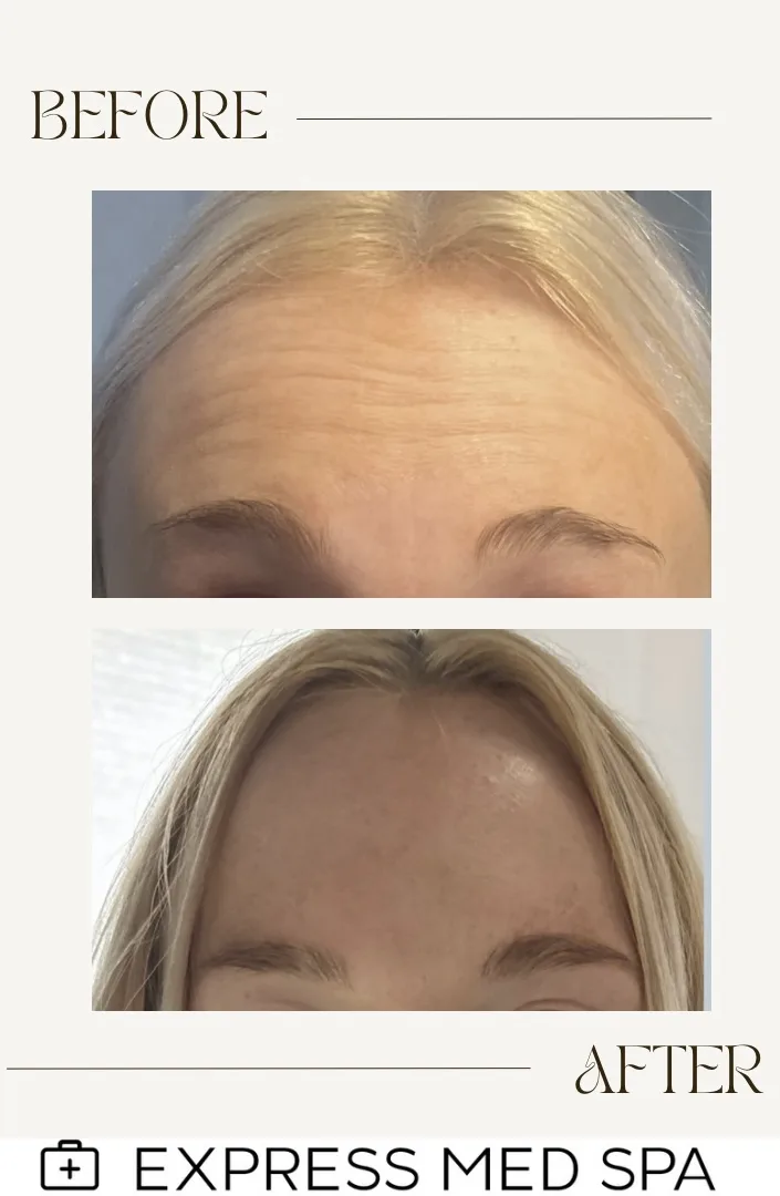 Unretouched clinical before and after portfolio photograph displaying 10 units of neurotoxin injected to frontalis muscle with preserved brow symmetry