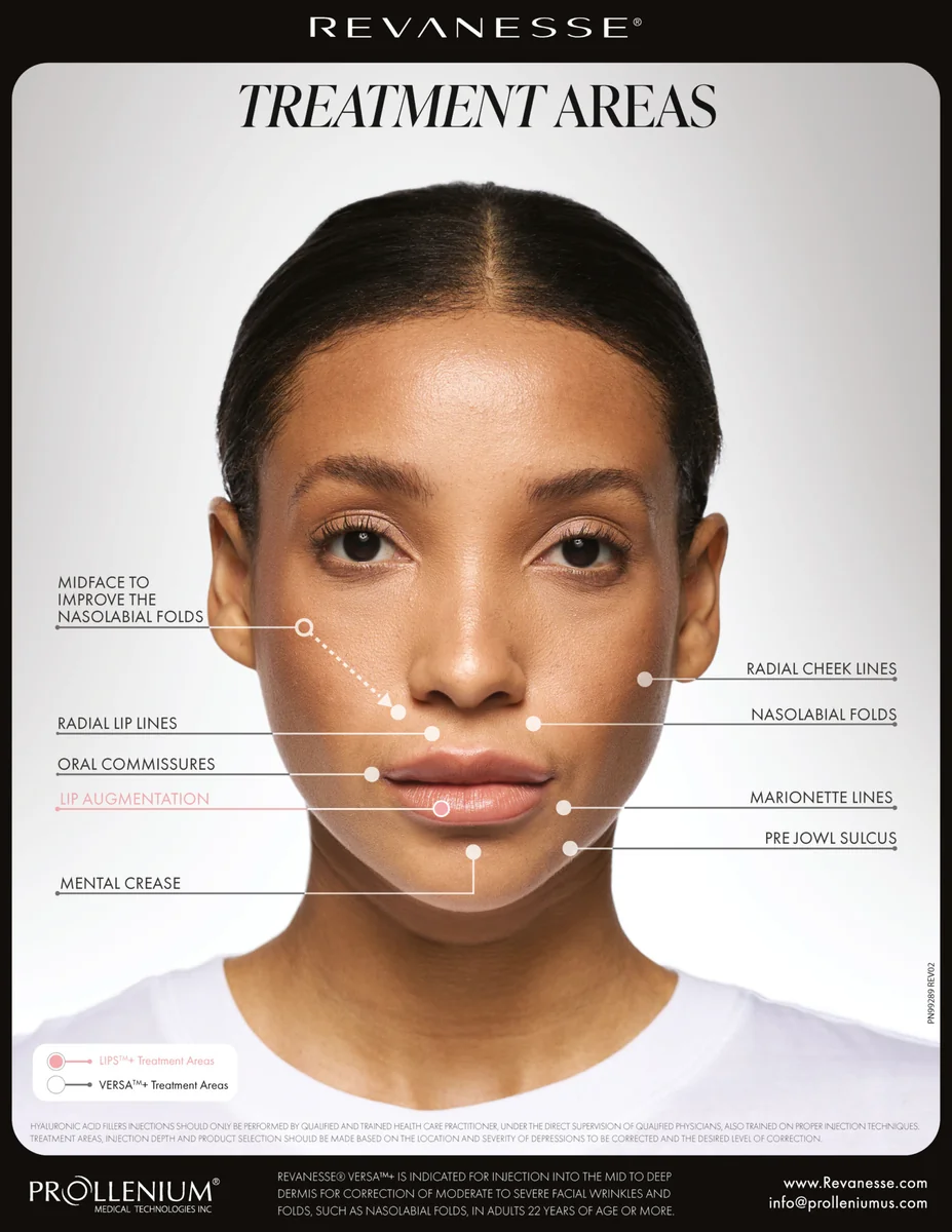 Facial anatomy diagram mapping dermal filler injection zones including cheeks, nasolabial folds, and lips.