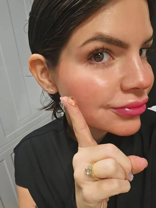 Aesthetic nurse holding a 1 mL droplet of dermal filler on her finger to show actual volume.